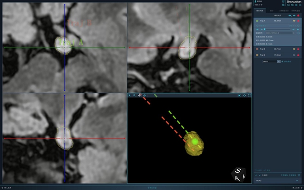 插入腫瘤的2根電極示意圖。重醫(yī)附屬兒童醫(yī)院供圖
