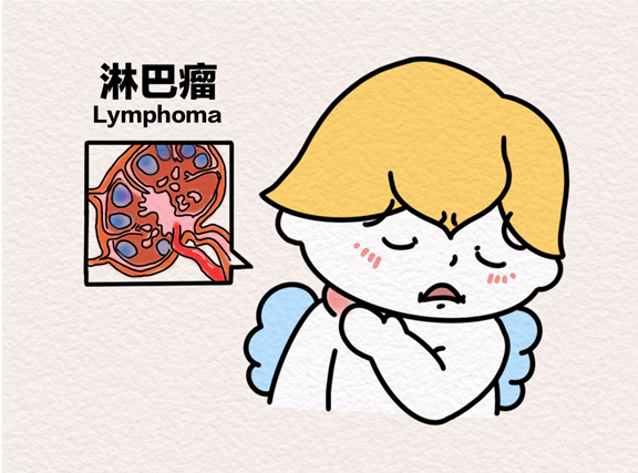 淋巴瘤。重慶松山醫(yī)院供圖