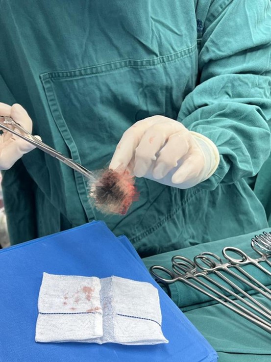 原置換瓣膜周邊已布滿血管翳和血栓。重慶康心醫(yī)院供圖