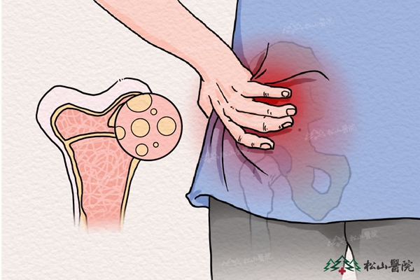 骨髓炎示意圖。重慶松山醫(yī)院供圖