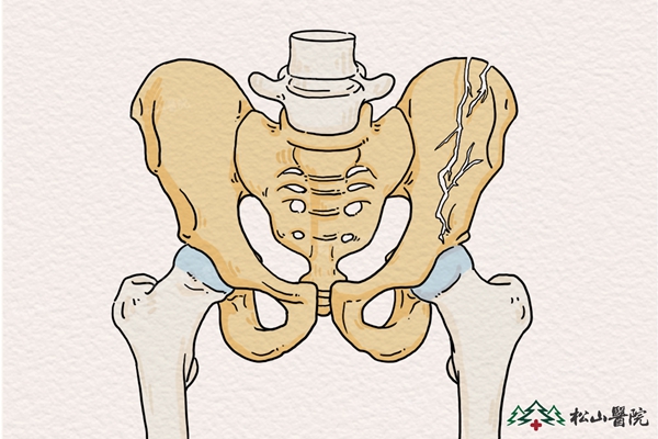 骨盆骨折示意圖。重慶松山醫(yī)院供圖
