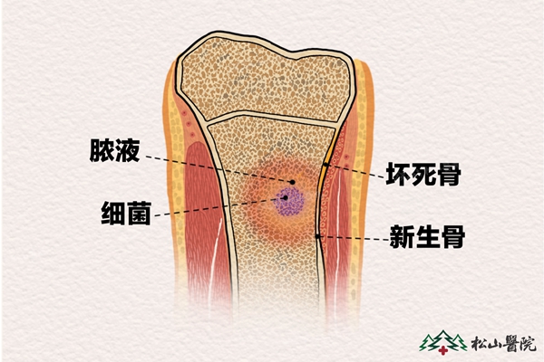 骨髓炎示意圖。重慶松山醫(yī)院供圖