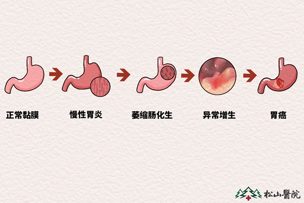 胃癌發(fā)展進(jìn)程。重慶松山醫(yī)院供圖