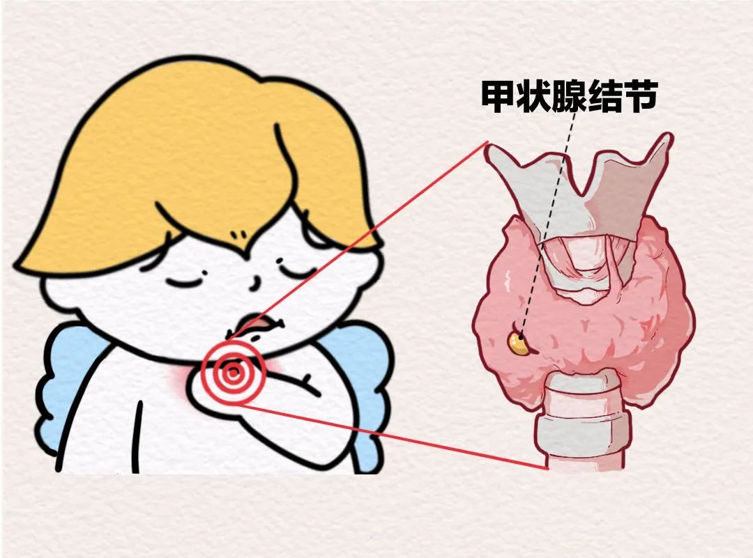 甲狀腺結(jié)節(jié)。重慶松山醫(yī)院供圖