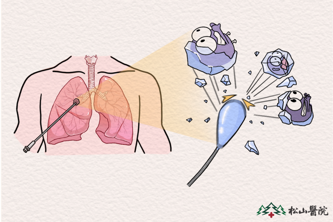 冷凍消融。重慶松山醫(yī)院供圖