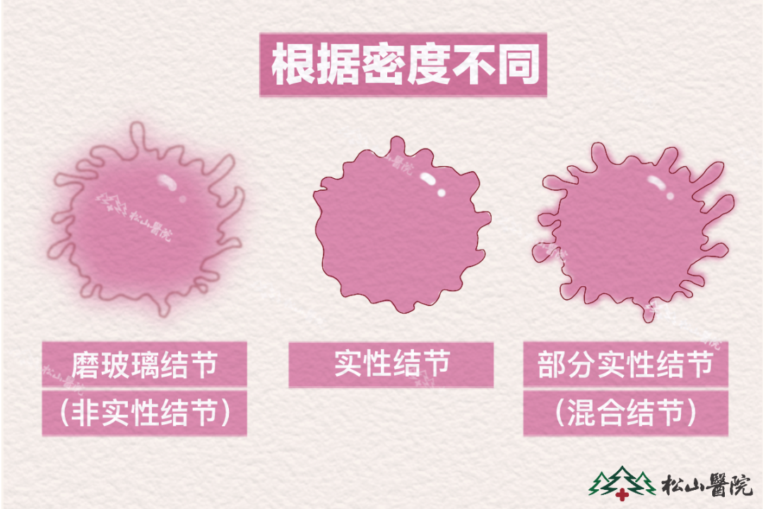 肺結(jié)節(jié)。重慶松山醫(yī)院供圖