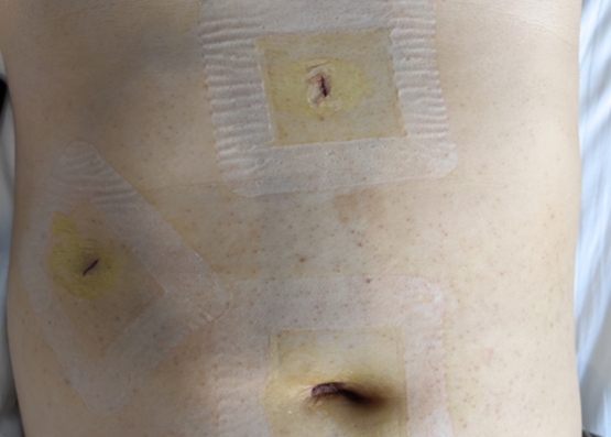 傷口情況。重慶手術(shù)醫(yī)院供圖