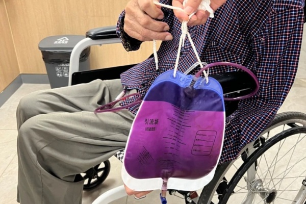 秦大爺出現(xiàn)“紫色尿液”。重慶西區(qū)醫(yī)院供圖