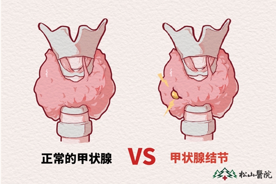 甲狀腺。重慶松山醫(yī)院供圖
