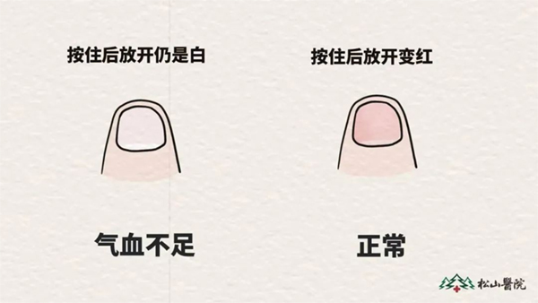 氣血不足與氣血充足時(shí)指甲對比。重慶松山醫(yī)院供圖