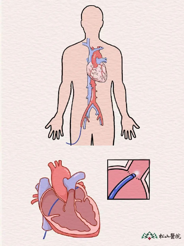 示意圖。重慶松山醫(yī)院供圖