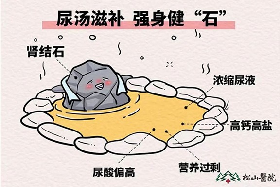 腎結(jié)石。重慶松山醫(yī)院供圖