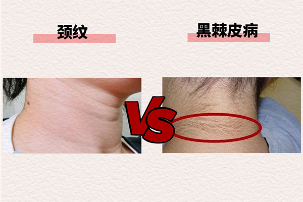 頸紋和黑棘皮病的區(qū)別。重慶松山醫(yī)院供圖