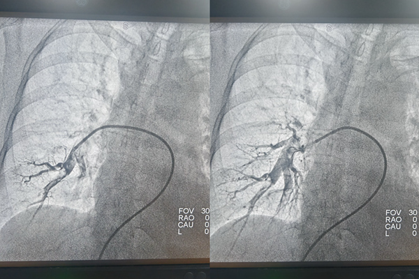 手術(shù)前后肺動(dòng)脈造影對(duì)比。重慶兩江新區(qū)人民醫(yī)院供圖