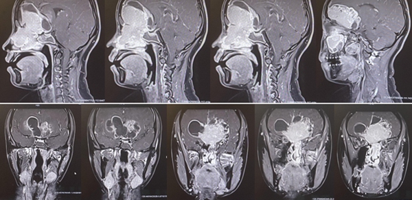 小于術(shù)前的磁共振，能夠清晰看到巨大的腫瘤，像豎起的“啞鈴”一樣，連通顱內(nèi)和鼻腔。重慶醫(yī)科大學(xué)附屬第二醫(yī)院供圖
