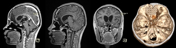 從術(shù)后磁共振和CT檢查看到，腫瘤已經(jīng)被全切，腦組織恢復(fù)很完美，顱底使用鈦板修復(fù)。重慶醫(yī)科大學(xué)附屬第二醫(yī)院供圖