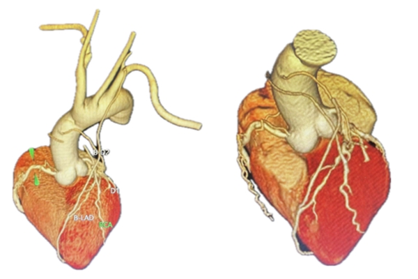 向先生冠脈造影三維重建圖。重慶醫(yī)科大學(xué)附屬第二醫(yī)院供圖