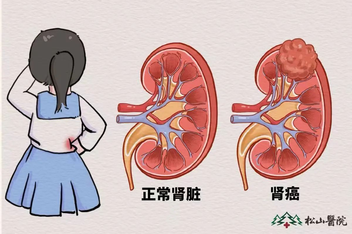 腎臟。重慶松山醫(yī)院供圖