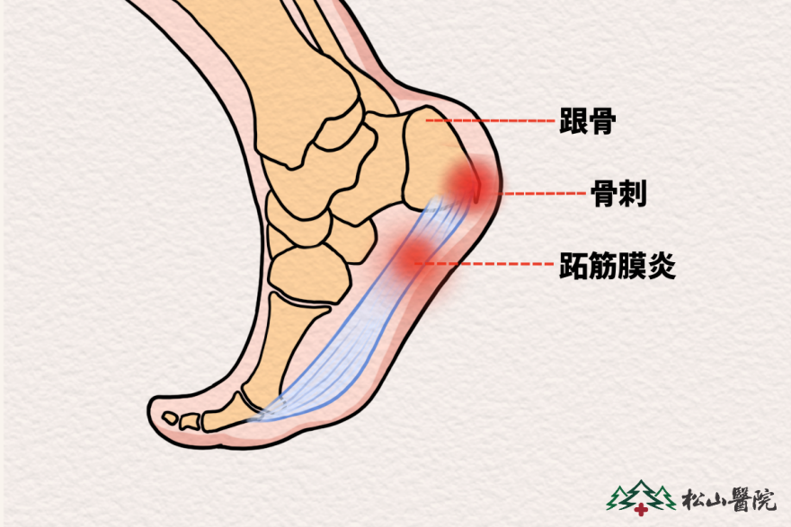 跖筋膜炎、跟骨骨刺。重慶松山醫(yī)院供圖