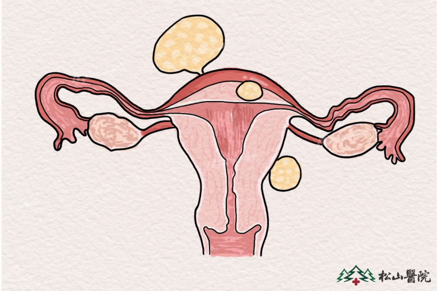 子宮肌瘤。重慶松山醫(yī)院供圖
