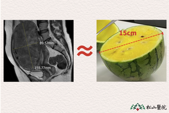 患者子宮肌瘤情況。重慶松山醫(yī)院供圖