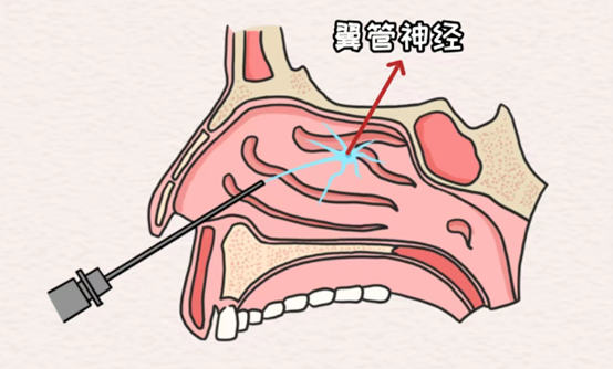 示意圖。重慶松山醫(yī)院供圖