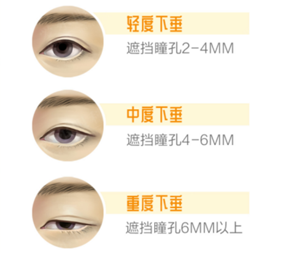 上瞼下垂示意圖。重慶南坪愛爾眼科醫(yī)院供圖