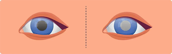 白內(nèi)障。重慶南坪愛爾眼科醫(yī)院供圖