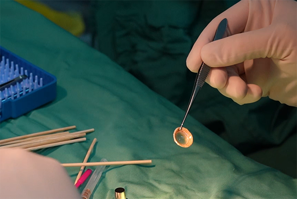 角膜移植。重慶普瑞眼科醫(yī)院供圖